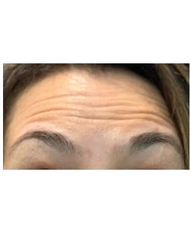 Before Image: Botox – Forehead and Glabella