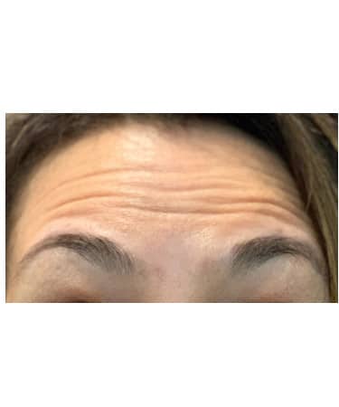 Botox – Forehead and Glabella