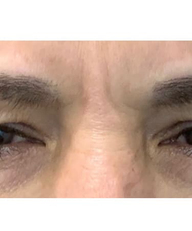 After Image: Botox – Forehead and Glabella - front