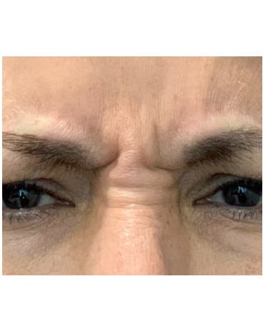 Before Image: Botox – Forehead and Glabella - front