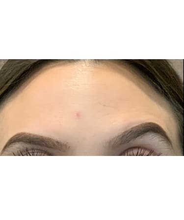 After Image: Xeomin – Forehead and Glabella