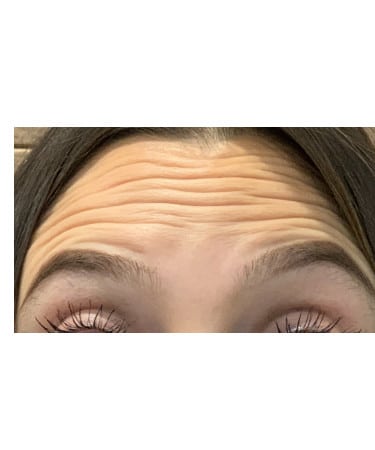Before Image: Xeomin – Forehead and Glabella
