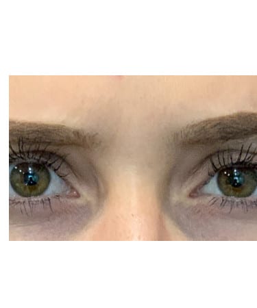 After Image: Xeomin – Forehead and Glabella - front