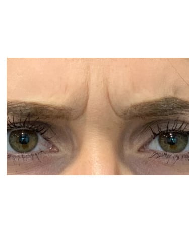 Before Image: Xeomin – Forehead and Glabella - front