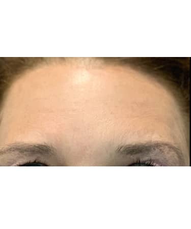 Xeomin – Forehead, Glabella, Chin, Upper Lip