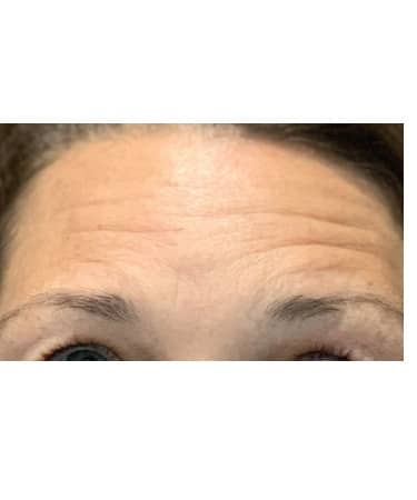 Xeomin – Forehead, Glabella, Chin, Upper Lip