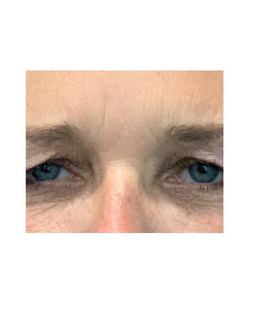 After Image: Xeomin – Forehead, Glabella, Chin, Upper Lip - front