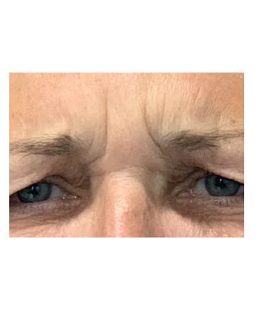 Before Image: Xeomin – Forehead, Glabella, Chin, Upper Lip - front