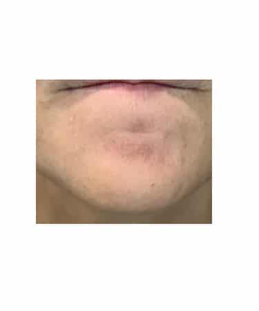 After Image: Xeomin – Forehead, Glabella, Chin, Upper Lip - front
