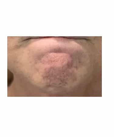 Before Image: Xeomin – Forehead, Glabella, Chin, Upper Lip - front