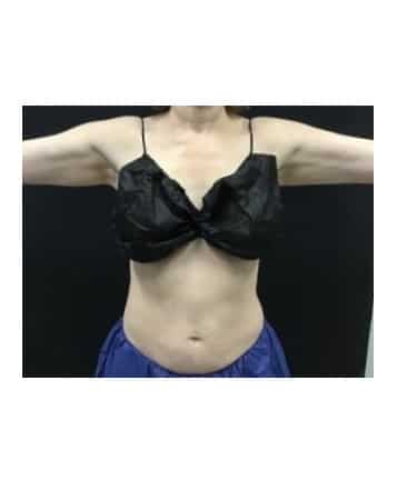 After Image: CoolSculpting – Upper & lower abdomen - front