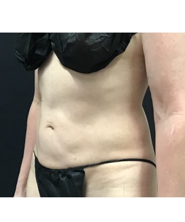 After Image: CoolSculpting – Upper & lower abdomen - front
