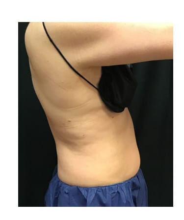 After Image: CoolSculpting – Upper & lower abdomen - front