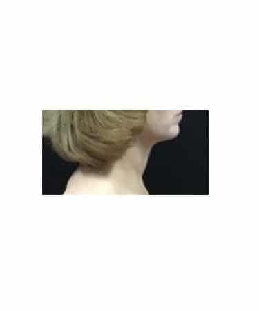 After Image: CoolSculpting – Submental area (under chin) - front