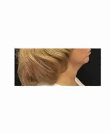 Before Image: CoolSculpting – Submental area (under chin) - front
