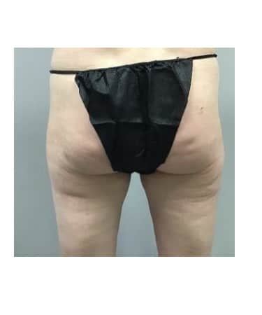 CoolSculpting – Inner thighs, Outer thigh, and Banana Roll