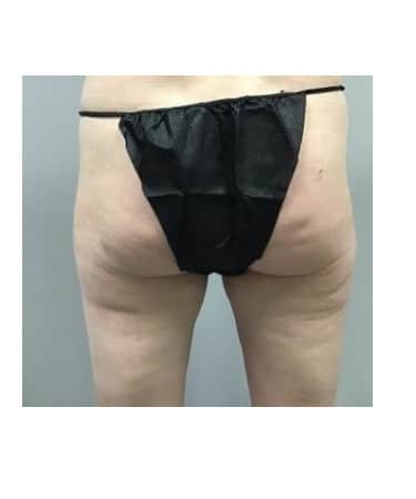 Before Image: CoolSculpting – Inner thighs, Outer thigh, and Banana Roll - front