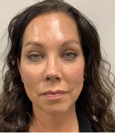 After Image: Dermal Filler – Radiesse (cheeks) - front