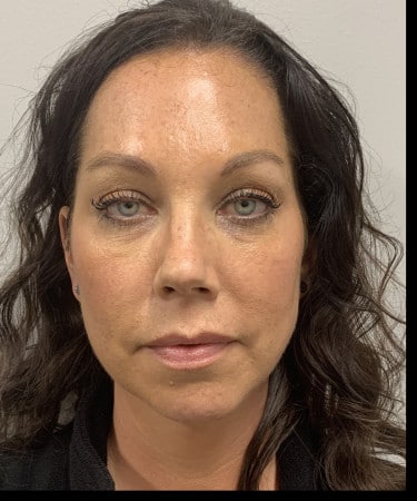 Before Image: Dermal Filler – Radiesse (cheeks) - front