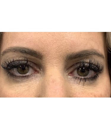 Before Image: Dermal Filler – Voluma (temples) - front