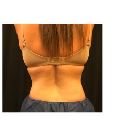 After Image: CoolSculpting – Flanks (lower love handles) - back
