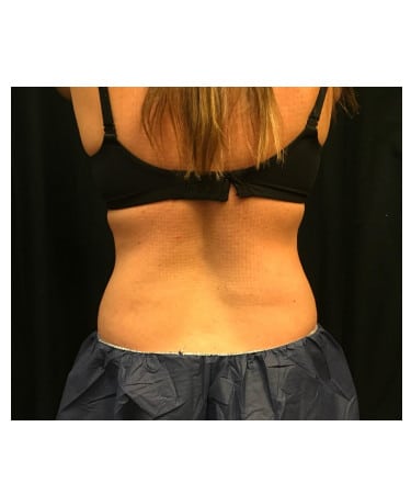 Before Image: CoolSculpting – Flanks (lower love handles) - back