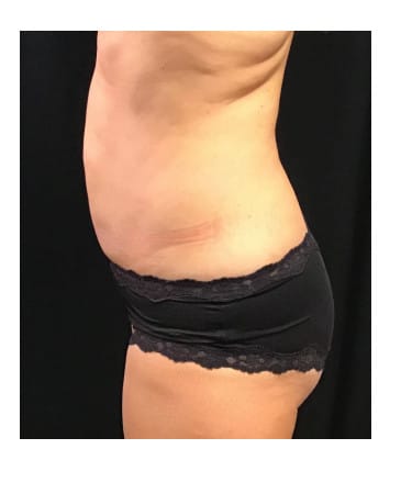 After Image: CoolSculpting – Abdomen & Flanks - left-side