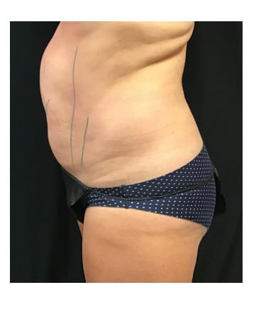 Before Image: CoolSculpting – Abdomen & Flanks - left-side
