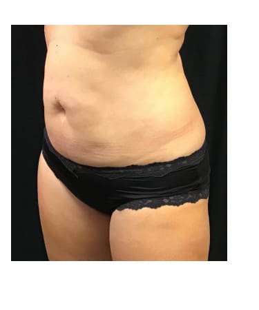 After Image: CoolSculpting – Abdomen & Flanks - left-front-oblique