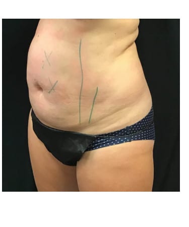 Before Image: CoolSculpting – Abdomen & Flanks - left-front-oblique