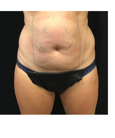 Before Image: CoolSculpting – Abdomen & Flanks - front