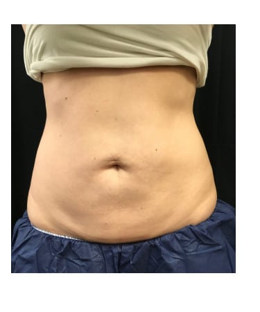 After Image: CoolSculpting – Abdomen & Flanks