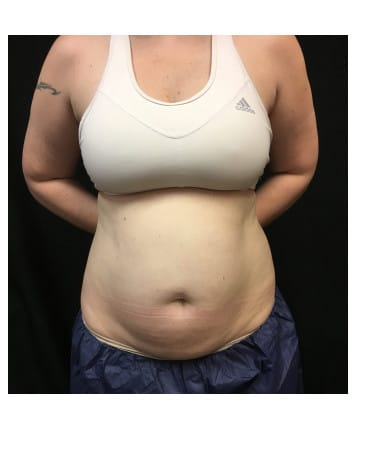 Before Image: CoolSculpting – Abdomen & Flanks