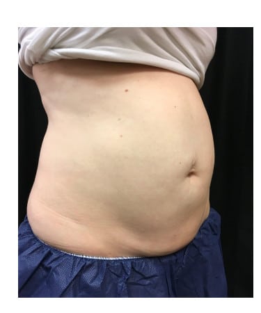After Image: CoolSculpting – Abdomen & Flanks - right-front-oblique