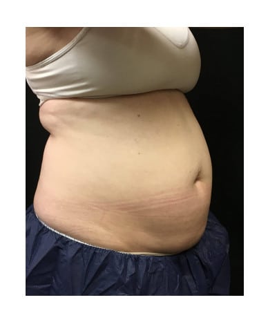 Before Image: CoolSculpting – Abdomen & Flanks - right-front-oblique