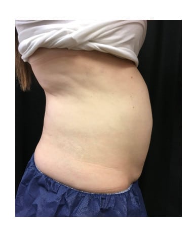 After Image: CoolSculpting – Abdomen & Flanks - right-side