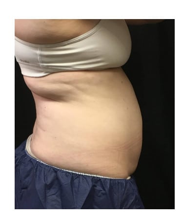 Before Image: CoolSculpting – Abdomen & Flanks - right-side