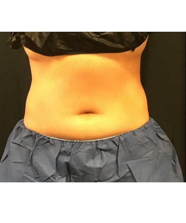 After Image: CoolSculpting – Upper & Lower Abdomen