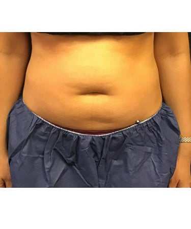 Before Image: CoolSculpting – Upper & Lower Abdomen