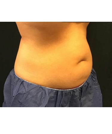 Before Image: CoolSculpting – Upper & Lower Abdomen - right-front-oblique