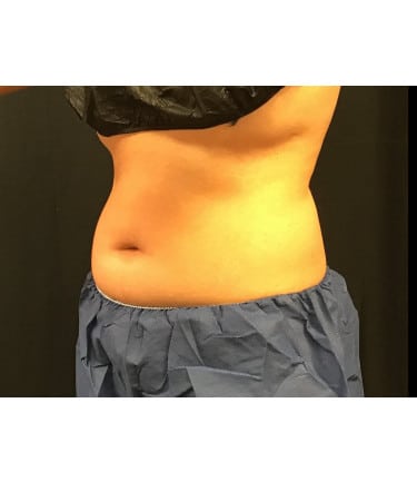 After Image: CoolSculpting – Upper & Lower Abdomen - left-front-oblique