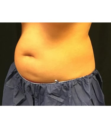 Before Image: CoolSculpting – Upper & Lower Abdomen - left-front-oblique