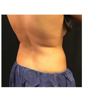 Before Image: CoolSculpting – Upper & Lower Flanks - right-front-oblique