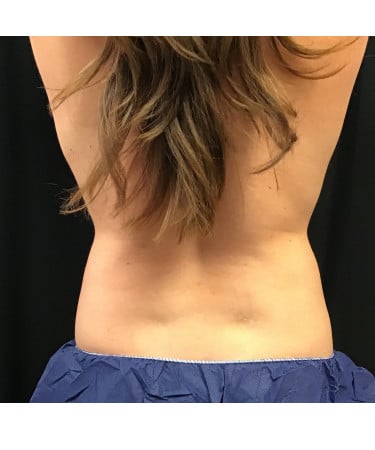 After Image: CoolSculpting – Flanks (lower love handles) - back