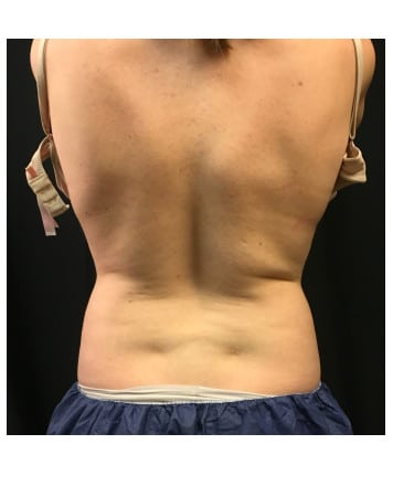 Before Image: CoolSculpting – Flanks (lower love handles) - back