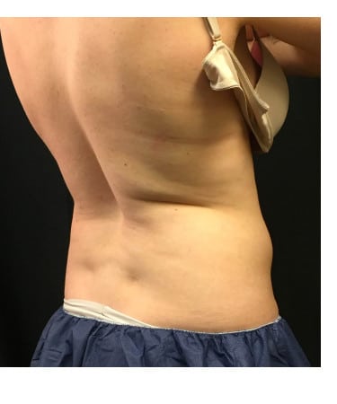 Before Image: CoolSculpting – Flanks (lower love handles) - right-front-oblique