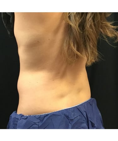 After Image: CoolSculpting – Flanks (lower love handles) - left-front-oblique