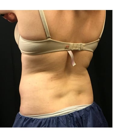 Before Image: CoolSculpting – Flanks (lower love handles) - left-front-oblique