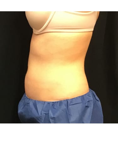 After Image: CoolSculpting – Abdomen - left-side
