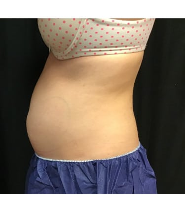 Before Image: CoolSculpting – Abdomen - left-side